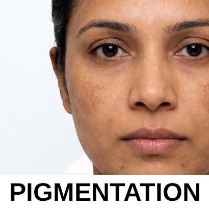 Pigmentation